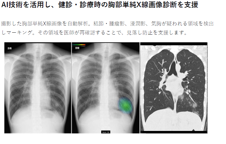 AI技術を活用し、健診・診療時の胸部単純X線画像診断を支援